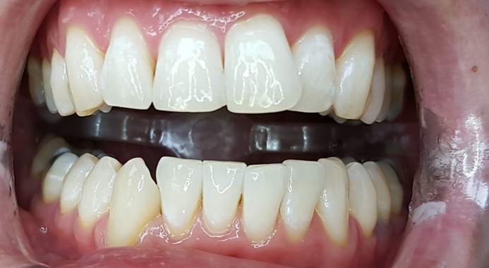  Bleaching nach 60 Minuten